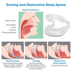 Anti-Snoring Mouthpiece